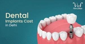 dental implant cost in delhi