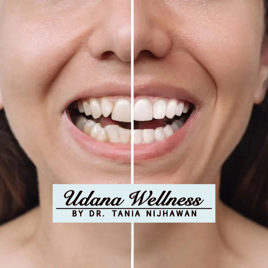 Invisalign before and after