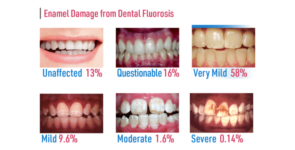 dental fluorosis composition 1536x930 1 e1765866485330