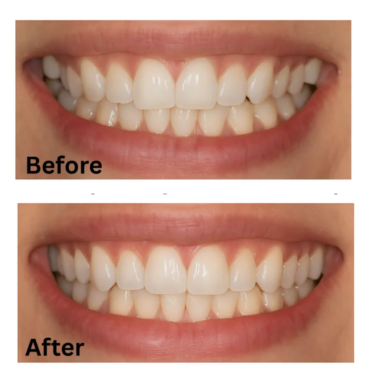 Invisalign aligners 28 12