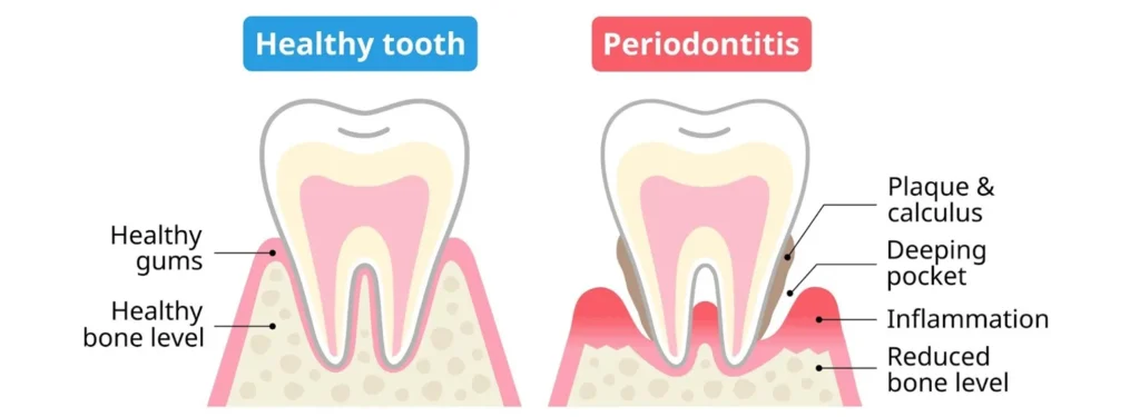 Gingivitis vs periodontitis