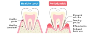 home 20 Gingivitis vs periodontitis