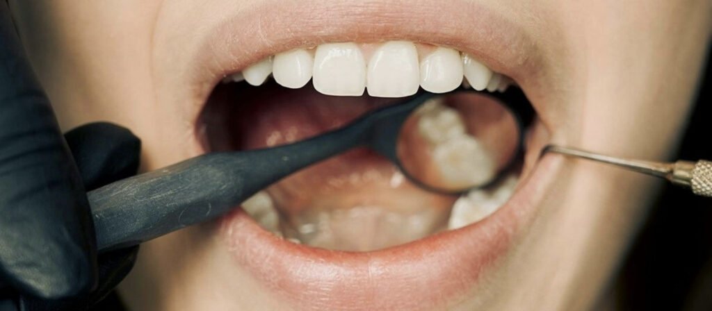 Fluoride and tooth decay
