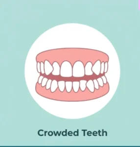 Croweded Teeth