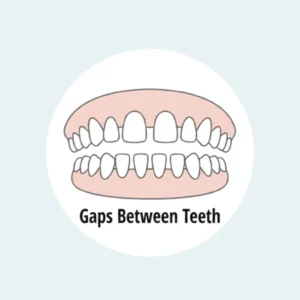 Gaps Between Teeth 1