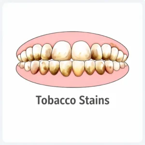 Tobacco stains on teeth close up