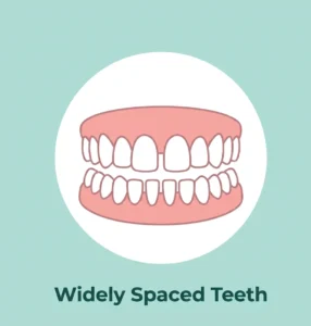 Widely Spaced Teeth