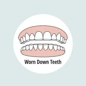 Worn Down Teeth 1