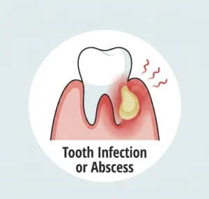 Tooth infection abscess requiring RCT specialist in Delhi