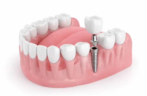 Dental Clinic in Vasant Vihar for Complete Oral Care