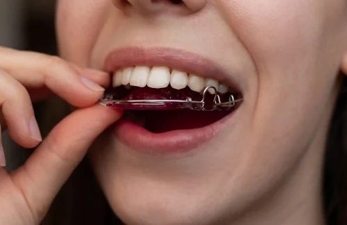 Retainers​ --After alignment treatments, retainers help maintain results and prevent teeth from shifting back.