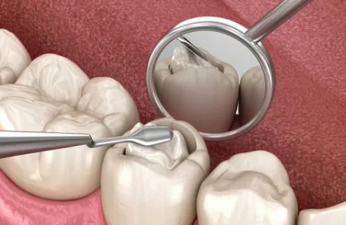 Tooth restoration treatment showing repair of damaged teeth with dental procedures