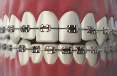 braces in vasant vihar