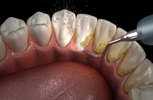 what-is-the-difference-between-scaling-and-cleaning-teeth
